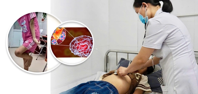 Cứu sống bé gái 12 tuổi bị viêm não tự miễn